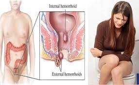 Obat Wasir Tradisional Untuk Ibu Menyusui