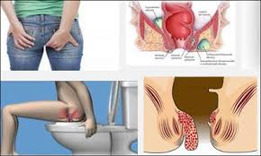 Obat Ambeien Alami Untuk Anak